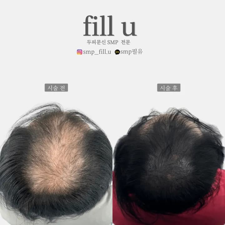 정수리 탈모 두피문신 SMP