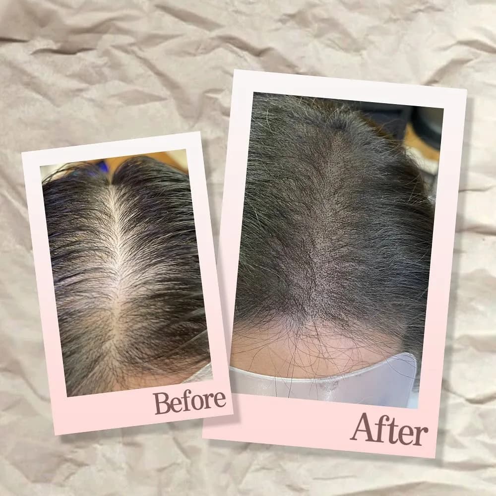 가르마탈모커버