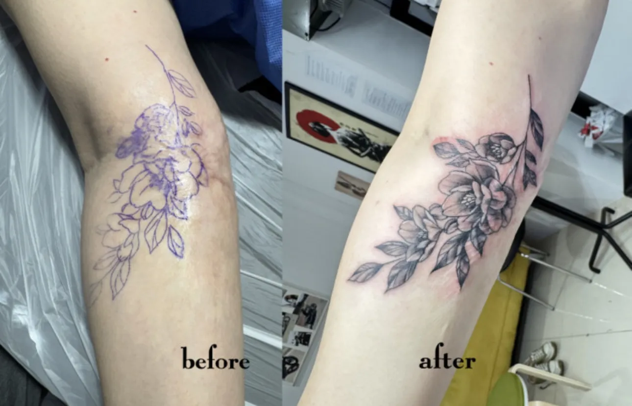 팔꿈치 화상자국 흉터 미니커버업