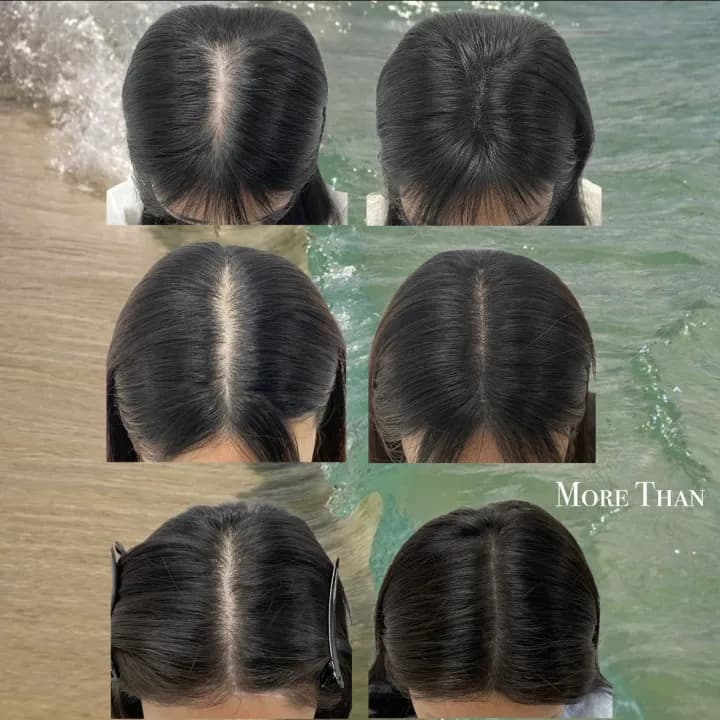 여성가르마탈모