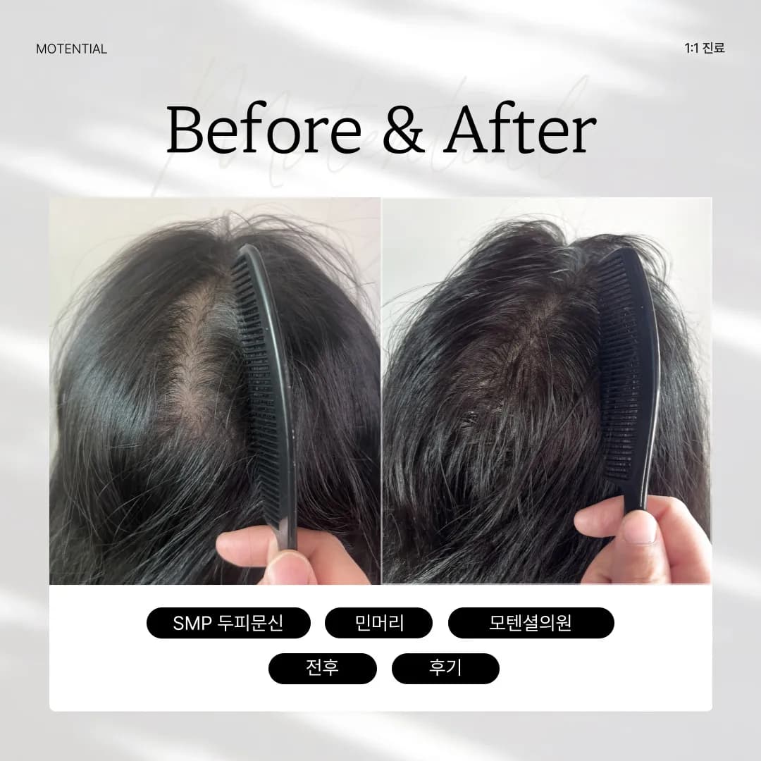 여자 뒷가마 + 헤어라인