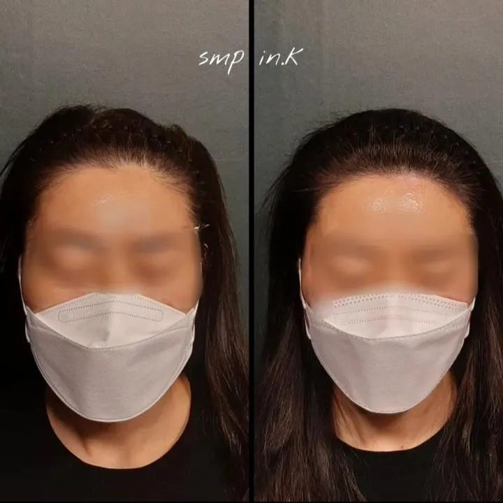 헤어라인 두피문신