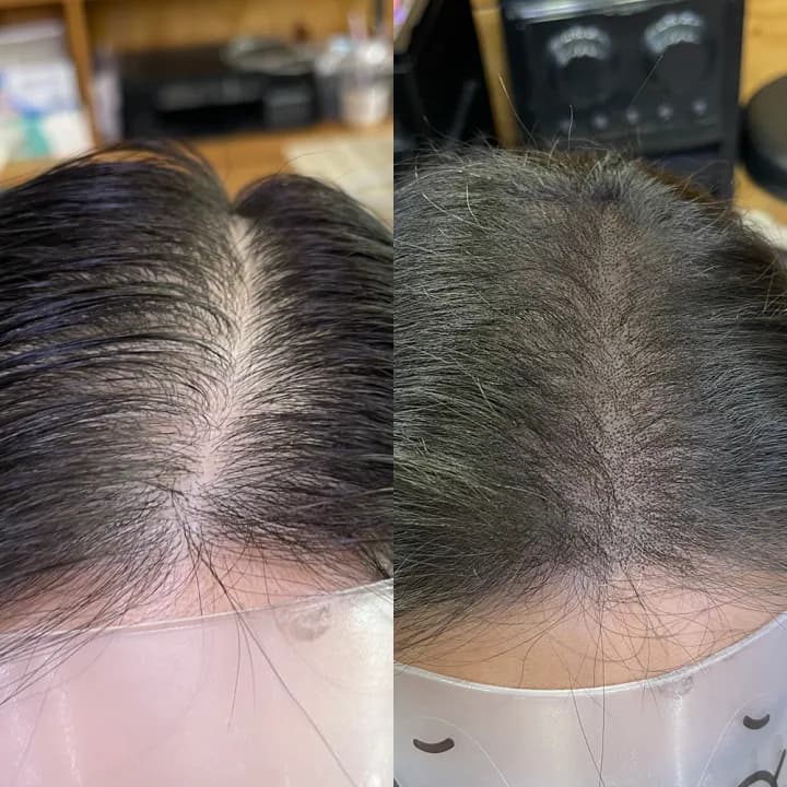 정수리탈모커버