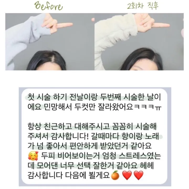 여성 가르마 탈모 커버