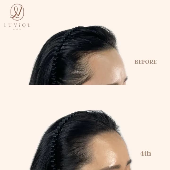 ํค์ด๋ผ์ธ ๋ฐ์๊ตฌ+์์ฑset (์นดํก ํ์น ์ถ๊ฐ์ 40%)