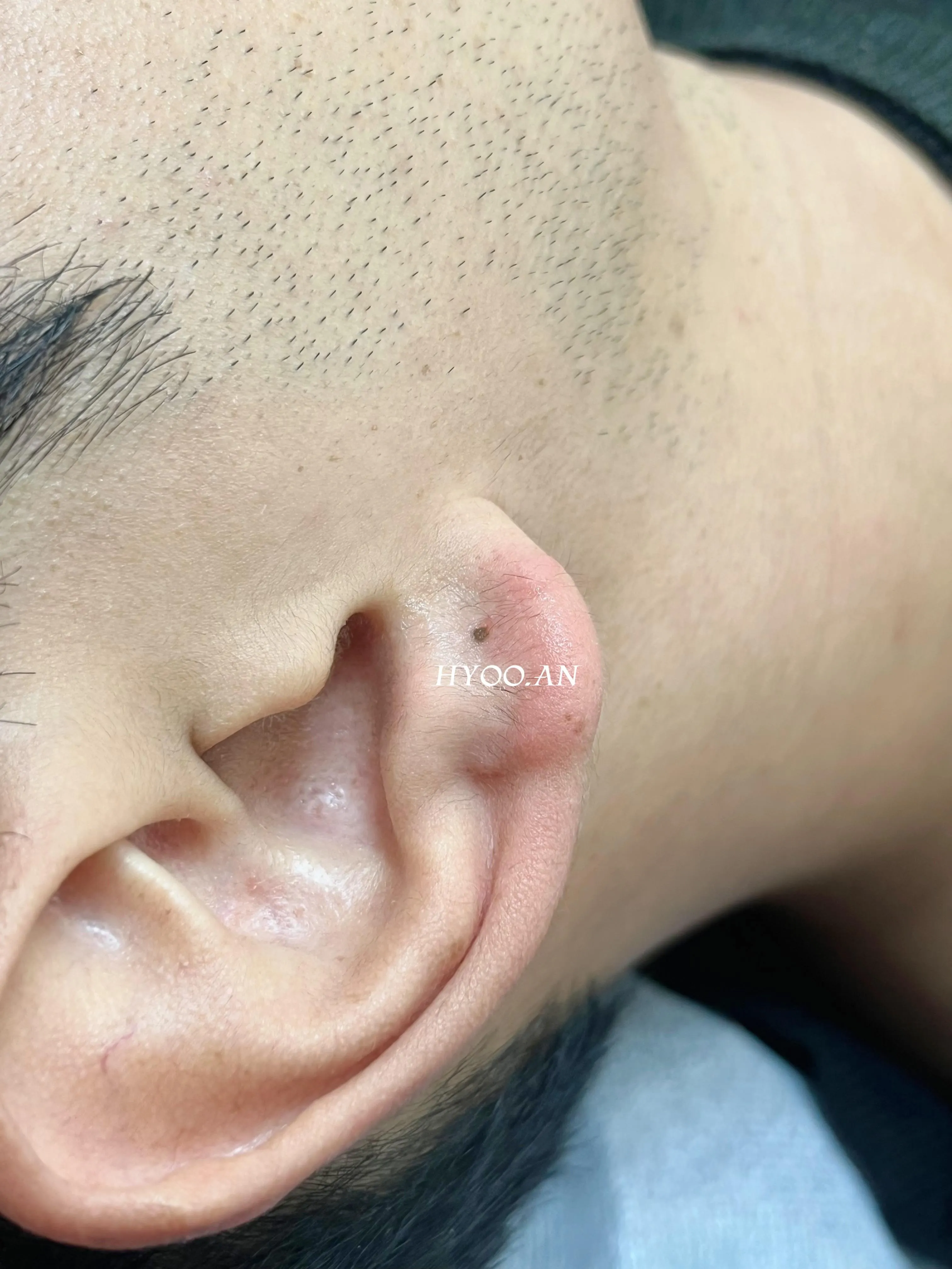 부자되는 재물점 | 귀 미인점 | 점타투 - 1