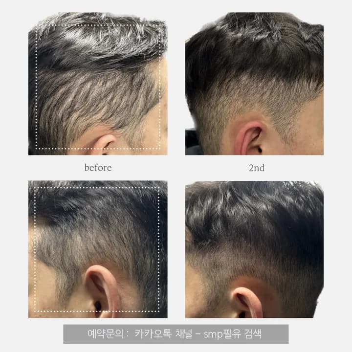 구렛나루 측두부 밀도보강 두피문신 SMP