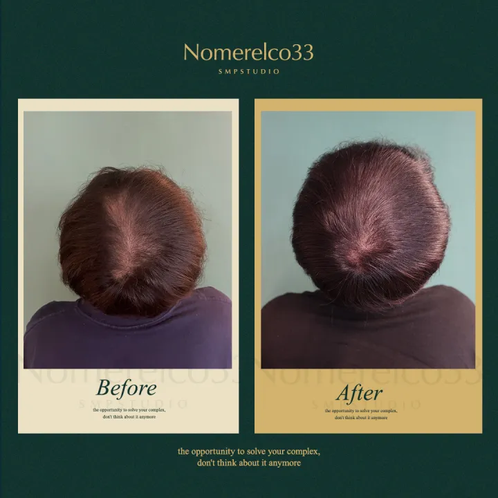 정수리 전체 밀도보강