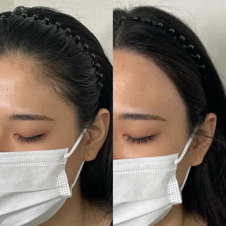 ํค์ด๋ผ์ธ ๋ผ์ธ ๊ธฐ๋ฒ