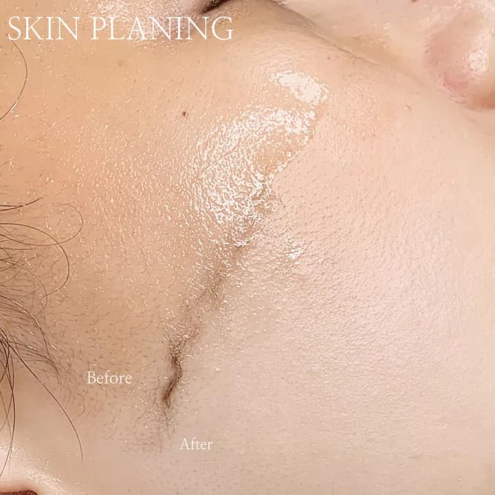스킨플래닝
