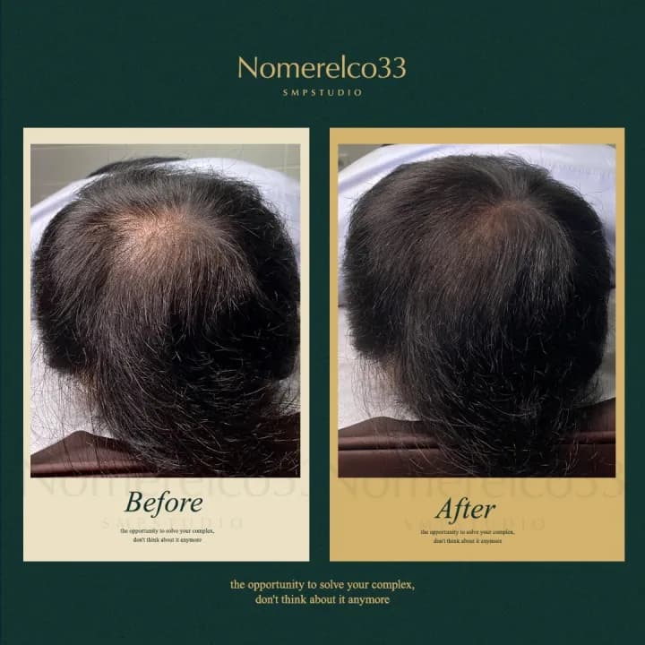남성 정수리 탈모 커버