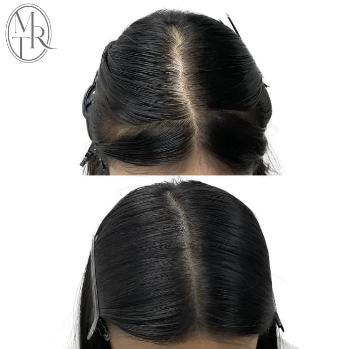 여성 가르마 탈모