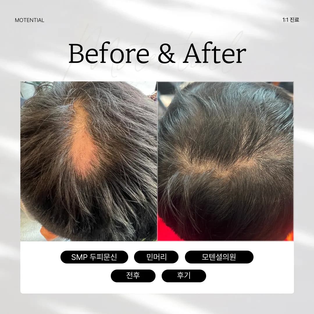 흉터 두피문신 - 1