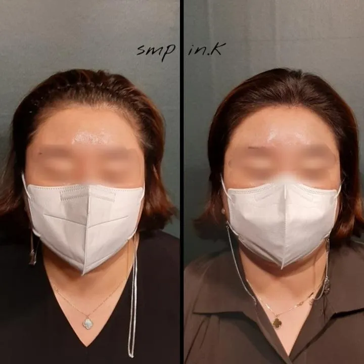 헤어라인두피문신