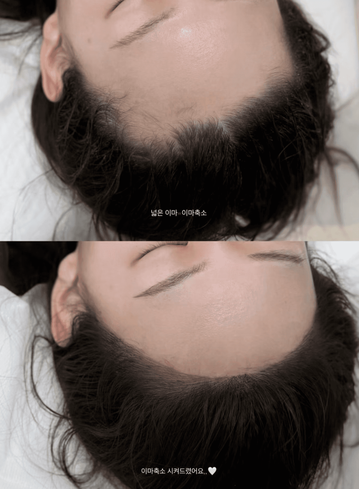 M자 헤어라인 자연스럽게 채우기|10월 마지막 이벤트