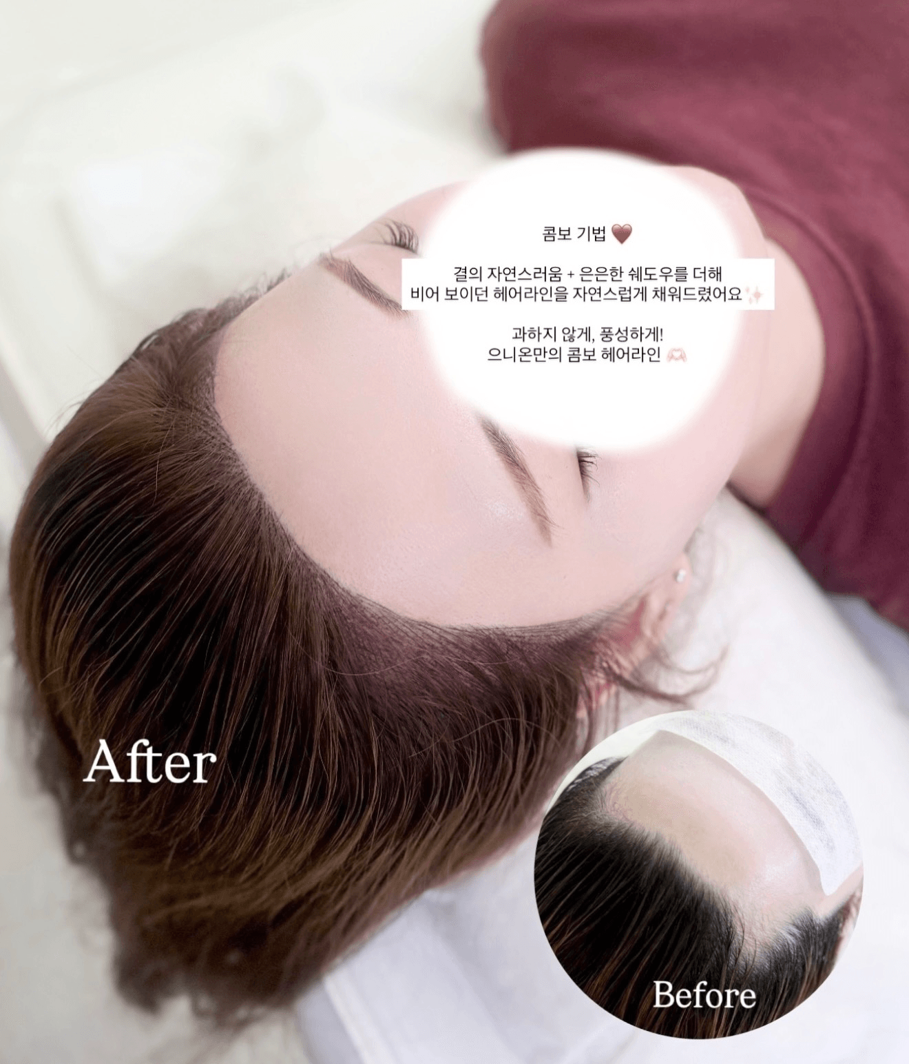 M자 빈틈은 자연스럽게, 얼굴선은 더 깔끔하게
