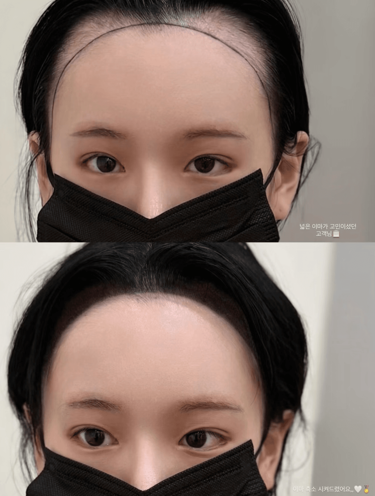 넓은 이마 고민, 헤어라인으로 자연스럽게 변화