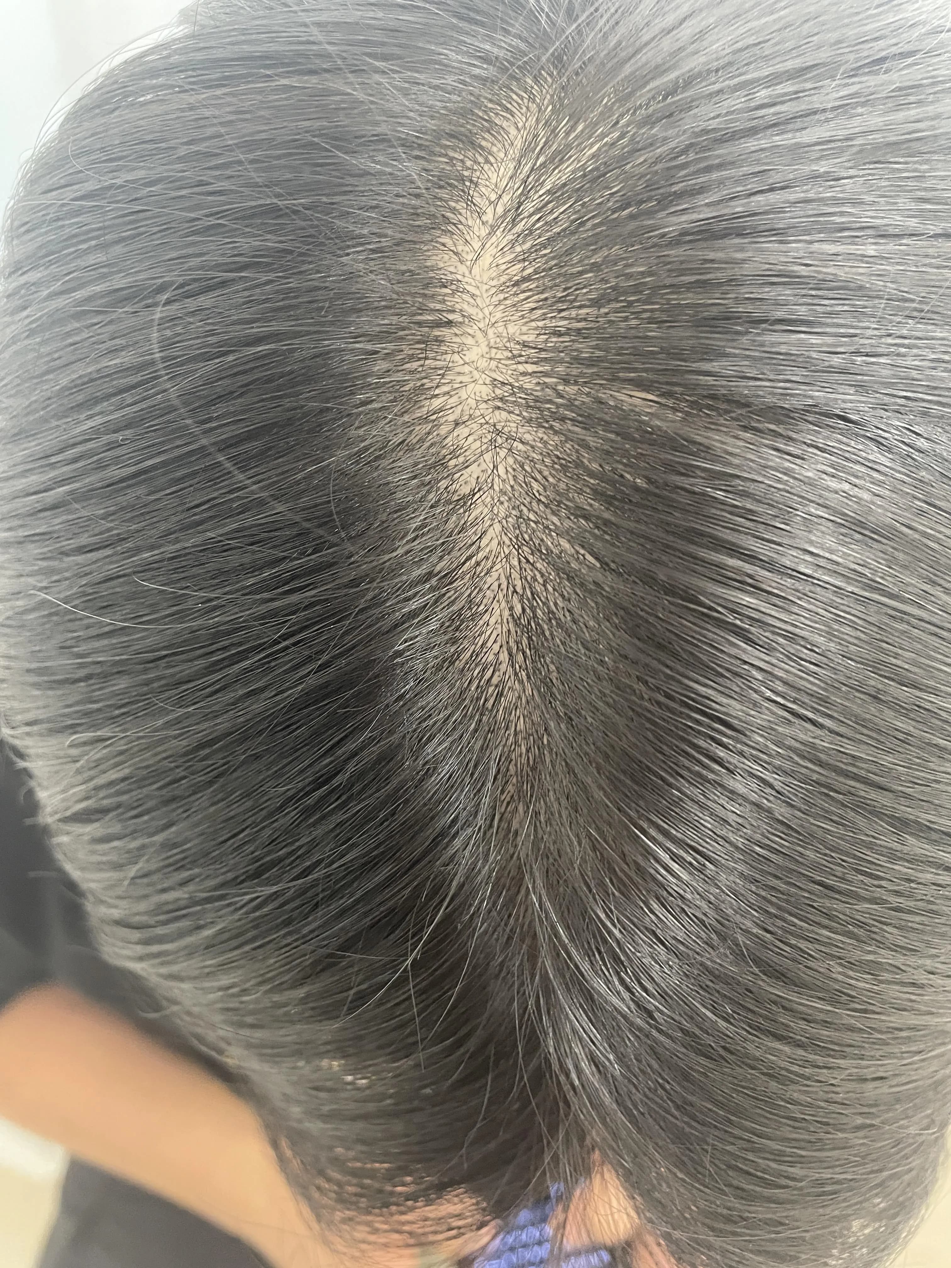 남성가르마 숱보강