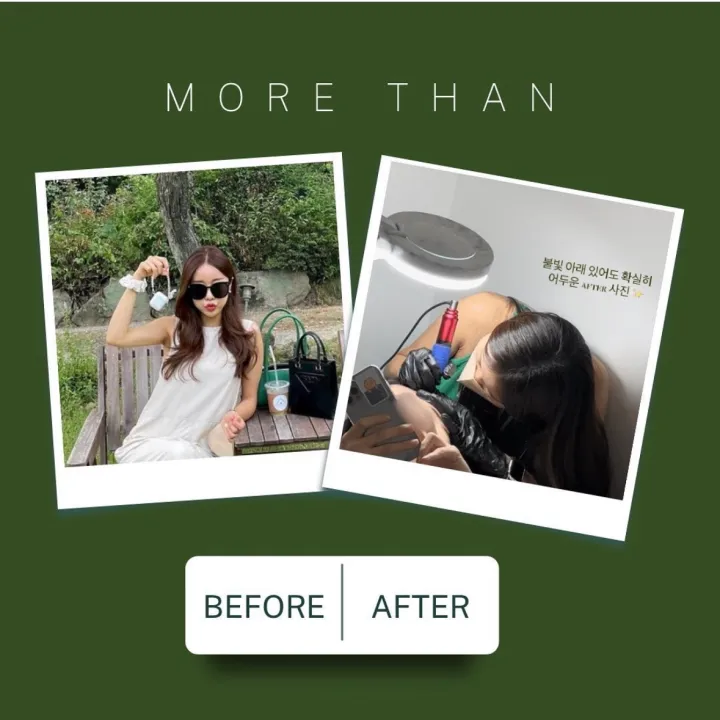 대표원장도 받아본 가르마탈모커버